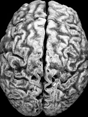 alzheimers_brain